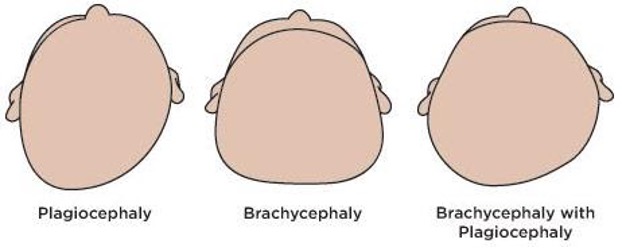 Plagiocephaly Helmets for babies Melbourne | Massons Healthcare